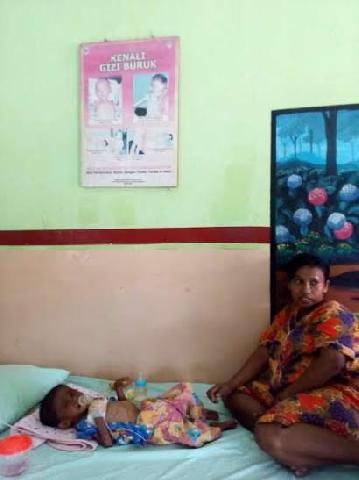 Alamak.., Anak Kurang Gizi di Temukan di Rohil